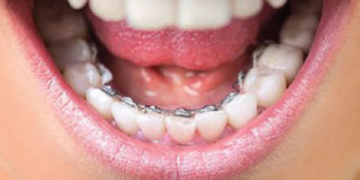Teeth Braces Cost In Bangladesh - [Detail Price List] - Dental